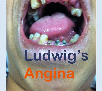 Ludwig's Angina- more than a toothache