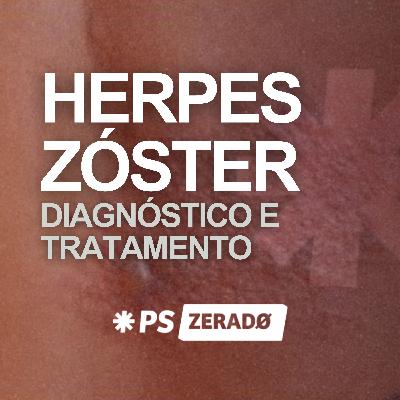 Herpes Zóster: diagnóstico rápido e tratamento correto Herpes Zóster: diagnóstico rápido e tratamento correto