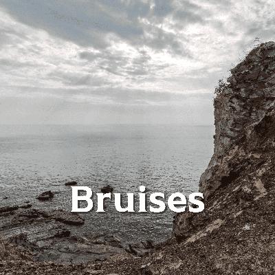 1.5: Bruises