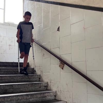 Physical scars of war: health ministry reports 6,000 amputations