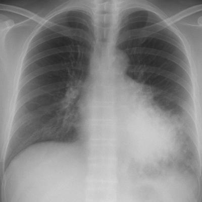Aspiration Pneumonia in the ED: Diagnosis & Management