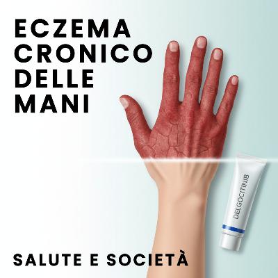 Delgocitinib è ora disponibile in Italia per l'eczema cronico delle mani Delgocitinib è ora disponibile in Italia per l'eczema cronico delle mani