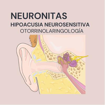 Hipoacusia Neurosensitiva