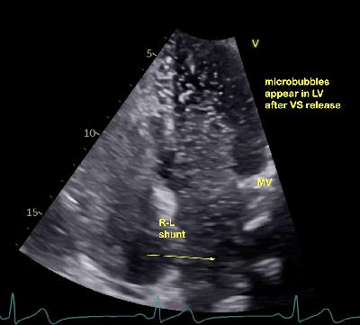 Patent Foramen Ovale (PFO): A Hidden Link in Stroke, TIA, Migraine and More — When to Close the Hole in the Heart