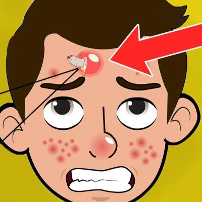 My Horrifying Zit Came Alive!