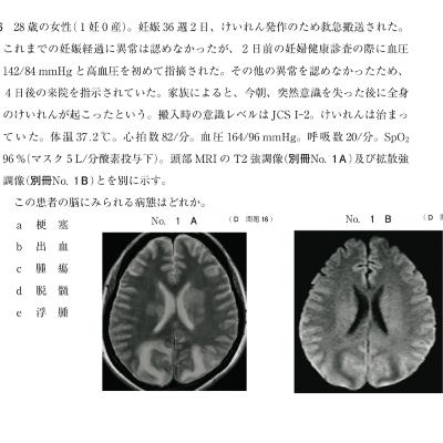 エピソード98: 妊婦の痙攣対応と薬剤