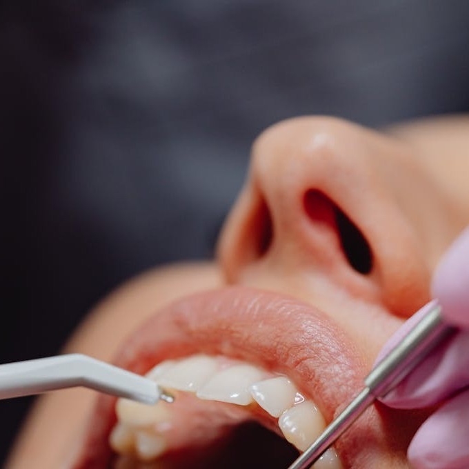 The OPTISMILE Podcast 109 - Airway Orthodontics & Palatal Expanders
