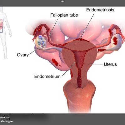 Endometriosis — A Fresh Look for Everyone Endometriosis — A Fresh Look for Everyone