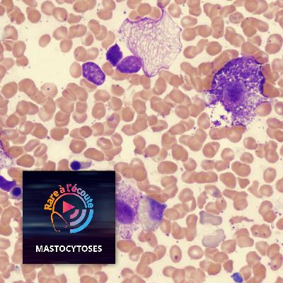 Maladie rare – La mastocytose, le point de vue du dermatologue