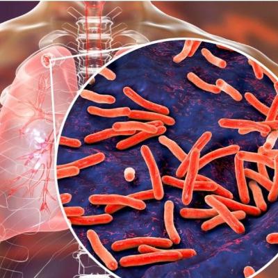 Tuberculosis