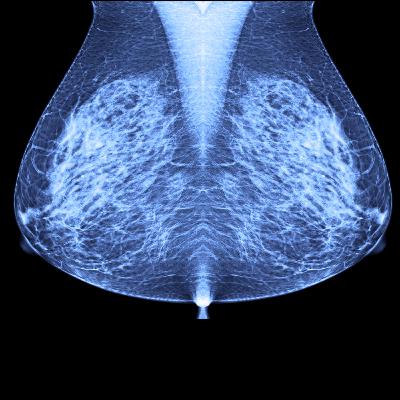 On Breast Malignancy and Military Burn Pit Exposure