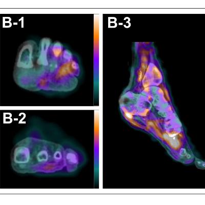 How New Imaging Tech is Fighting Critical Limb Ischemia