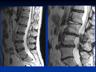 Regenerative Treatments for Lumbar Disc Disease
