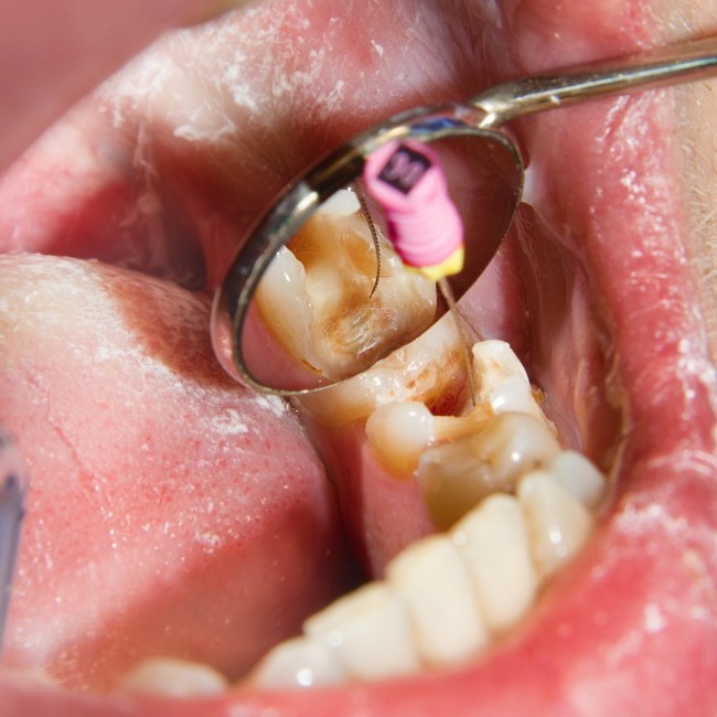 What Are the Risks of Avoiding a Root Canal