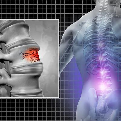 Audio Article: Research Explores Potential Association Between Oral Health and Osteoporotic Fracture Risk Audio Article: Research Explores Potential Association Between Oral Health and Osteoporotic Fracture Risk