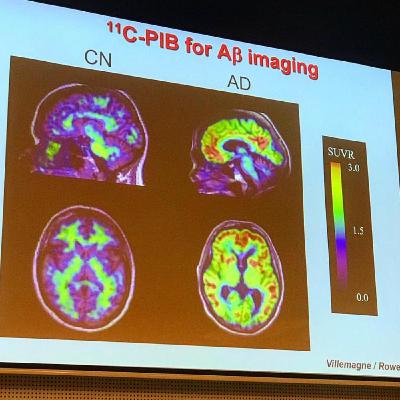 Ass. Prof. Michael Woodward: Amyloid PET Scan