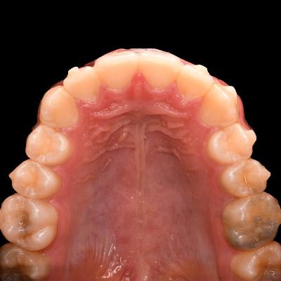 Audio Article: Researchers Investigate Additional Palatal Nerve and Artery Supply to the Maxillary Teeth