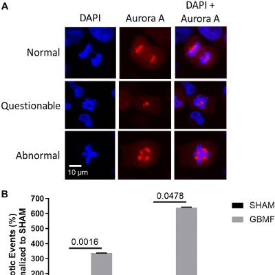 New Radiofrequency Therapy Slows Glioblastoma Growth and Targets Tumor Stem Cells