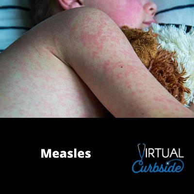 Episode 338: #78-4 Measles: Q&A