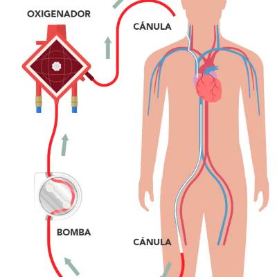ECMO VV! Màs alla del rescate. ECMO VV! Màs alla del rescate.