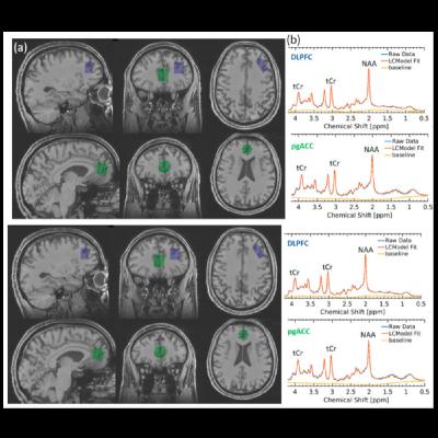 Creatine for Chronic Fatigue: Promising Findings and Practical Takeaways