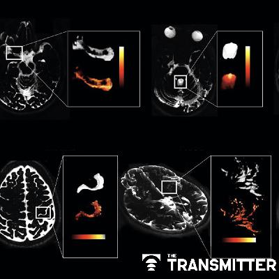 Noninvasive method lifts curtain on cerebrospinal-fluid dance in human brain Noninvasive method lifts curtain on cerebrospinal-fluid dance in human brain
