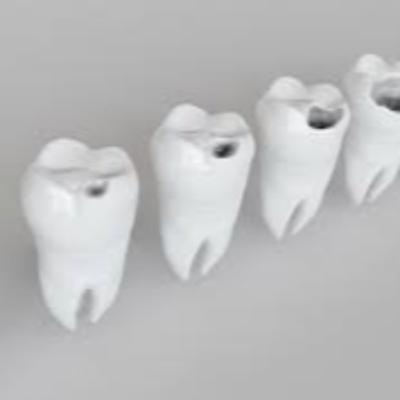 Caries dentales