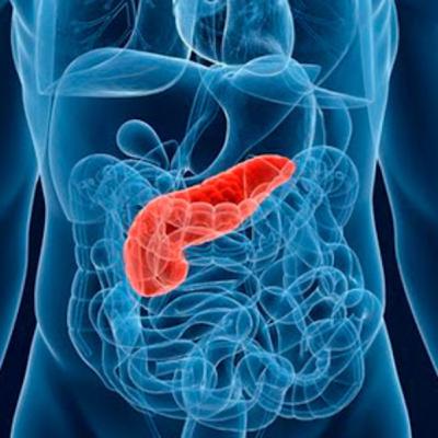 Recomendaciones nutricionales en pancreatitis aguda Recomendaciones nutricionales en pancreatitis aguda