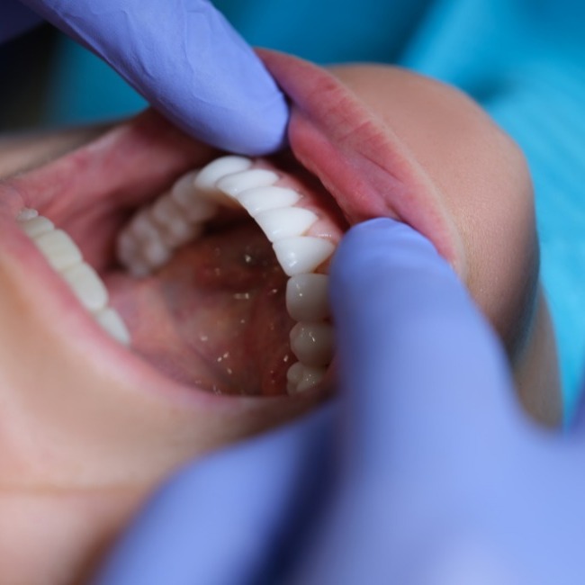 5 Tips to Keep Your Teeth Veneers Looking Brand New