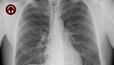 Diagnosis: TB or not TB? Diagnosis: TB or not TB?