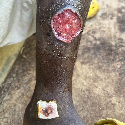 LAS ENFERMEDADES OLVIDADAS (NEGLECTED DISEASES) LAS ENFERMEDADES OLVIDADAS (NEGLECTED DISEASES)