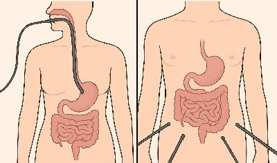 436. Endoscopy vs Laparoscopy and the Beginnings 436. Endoscopy vs Laparoscopy and the Beginnings