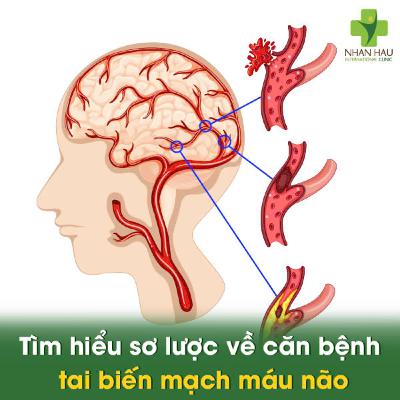 Tai biến mạch máu não: Nguyên nhân, triệu chứng và cách phòng ngừa hiệu quả Tai biến mạch máu não: Nguyên nhân, triệu chứng và cách phòng ngừa hiệu quả