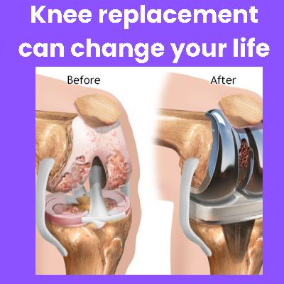 Modern Miracle of Knee Replacement: A Journey from Pain to Dance