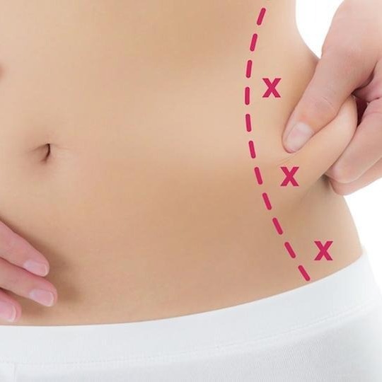What Are the Long-term Benefits of Liposuction What Are the Long-term Benefits of Liposuction