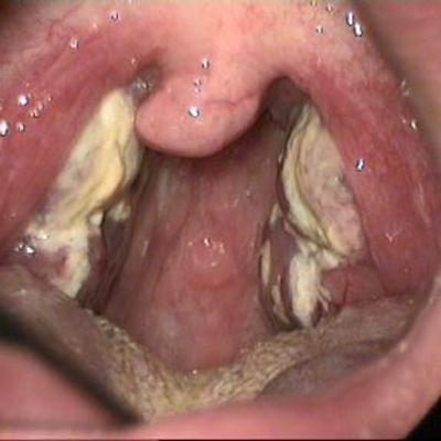 Ep 71: Mononucleosis, aka Mono or The Kissing Disease Ep 71: Mononucleosis, aka Mono or The Kissing Disease