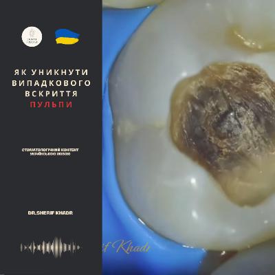 Як уникнути випадкового вскриття пульпи?