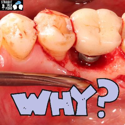 Marginal bone loss around Implants PART II
