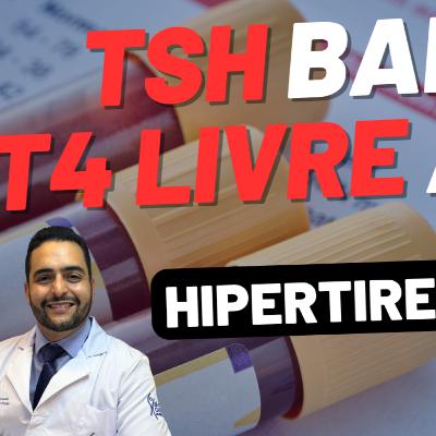 TSH BAIXO, T4 LIVRE ALTO - HIPERTIREOIDISMO POR DOENÇA DE GRAVES TSH BAIXO, T4 LIVRE ALTO - HIPERTIREOIDISMO POR DOENÇA DE GRAVES