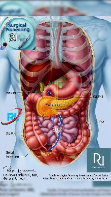 Laparoscopic Sleeve Gastrectomy Outcomes in Adolescents