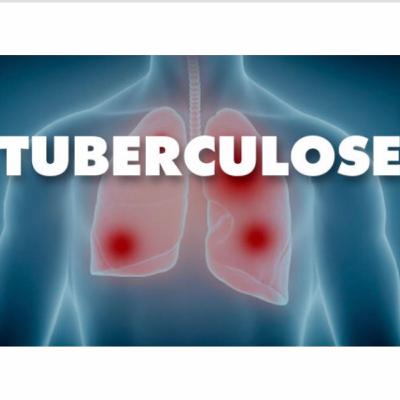 Tuberculose