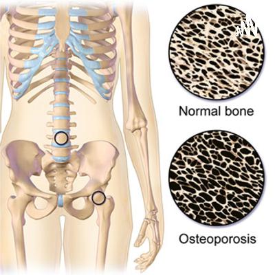 Osteoporosis Podcast