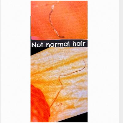 Morgellons Is Not A Mystery