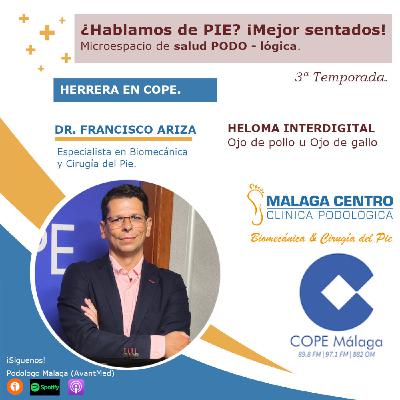 Heloma interdigital, ojo pollo ¿Hablamos de PIE? ¡Mejor sentados! 22 x 03 |Microespacio de salud podo-LÓGICA (26/03/2025