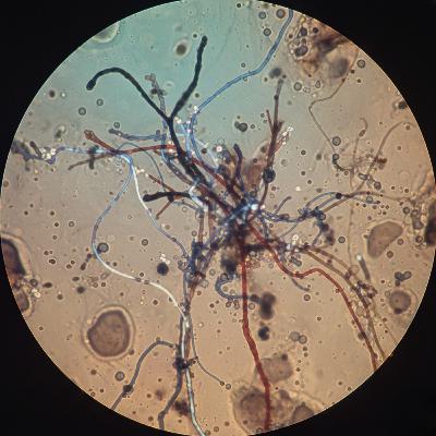 Confusion, Correction, and Flip Flopping on Morgellons.