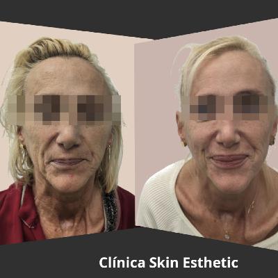 Tratamientos estéticos para Rejuvenecimiento facial