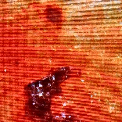 Morgellons Biopsy