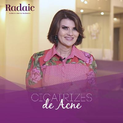 [T02EP07] Como tratar a cicatriz de acne?