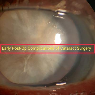 Early post operative complications of cataract surgery