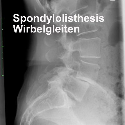 Spondylolisthesis - Wirbelgleiten